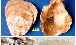 Bài thuốc chữa mồ hôi ra quá nhiều