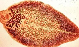 Nhiễm bệnh sán lá gan lớn do ăn rau sống