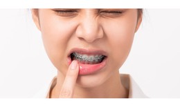 Hệ lụy của niềng răng sai c&#225;ch v&#224; c&#225;ch khắc phục