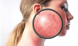 Người bệnh hen sử dụng corticoid kéo dài ảnh hưởng thế nào tới cơ thể?