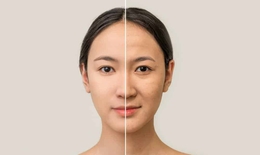 Nguyên nhân gây lão hóa da sớm và cách ngăn chặn