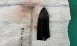 Lưỡi dao 10cm nằm trong bả vai nam thanh niên