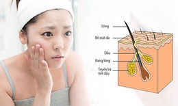 6 nguyên nhân gây da nhờn và cách khắc phục tại nhà