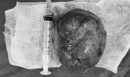 Phẫu thuật lấy thai k&#232;m cắt u xơ tử cung cho sản phụ bị u tiền đạo