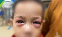 Nhiều trẻ gặp biến chứng nặng do đau mắt đỏ, chuy&#234;n gia khuyến c&#225;o g&#236;?