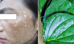 Da loang lổ v&#236; đắp l&#225; trầu kh&#244;ng l&#224;m trắng da, khắc phục thế n&#224;o?