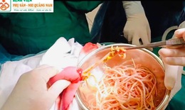 Hơn trăm con giun đũa trong bụng, bé 5 tuổi bị tắc ruột