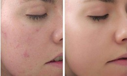 Những điều cần biết về peel da làm trắng