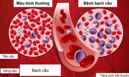 Hy hữu: T&#236;nh cờ ph&#225;t hiện ung thư m&#225;u sau khi bị r&#226;u t&#244;m chọc v&#224;o ng&#243;n tay