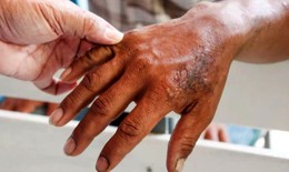 Bệnh phong tái bùng phát tại Mexico, lây lan tại 28/32 bang