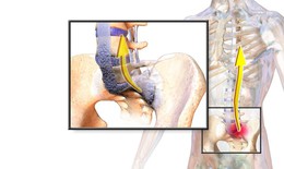 5 biện ph&#225;p giảm triệu chứng vi&#234;m cột sống d&#237;nh khớp