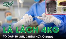 Mệt mỏi, v&#224;ng da, b&#225;c sĩ ph&#225;t hiện bệnh nh&#226;n l&#225; l&#225;ch to gấp 30 lần, chiếm nửa ổ bụng