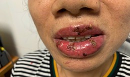 Mất tiền xăm môi, người phụ nữ nhận lại đôi môi bị nhiễm trùng 