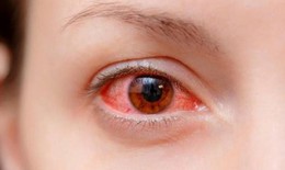 Thuốc uống, chườm mắt chữa đau mắt đỏ hiệu quả