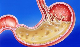 Người bị tr&#224;o ngược dạ d&#224;y - thực quản cần bỏ ngay những th&#243;i quen khiến bệnh nặng hơn