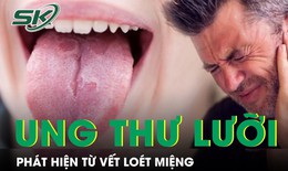 Ph&#225;t hiện ung thư lưỡi từ vết lo&#233;t miệng 