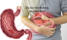 Lý do khiến bạn bị cơn đau dạ dày hành hạ