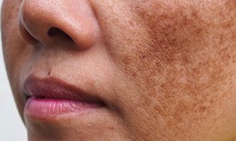 Nám, tàn nhang lâu năm điều trị sao cho hiệu quả
