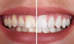 Tẩy trắng răng v&#224; những điều cần lưu &#253;