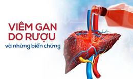 Viêm gan do rượu, bia và những biến chứng