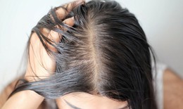 Tóc bết da dầu làm thế nào khắc phục?