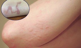 7 dấu hiệu nhiễm s&#225;n ch&#243; ở người kh&#244;ng thể bỏ qua