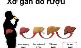 Vì sao rượu bia là sát thủ 'ăn mòn' lá gan?