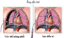 Tràn khí màng phổi ở những người hút thuốc lá