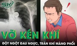 Đau ngực đột ngột, khó thở phát hiện tràn khí màng phổi, vỡ kén khí