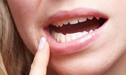 Sau 3 năm phẫu thuật, khối u ở môi có diễn biến bất thường