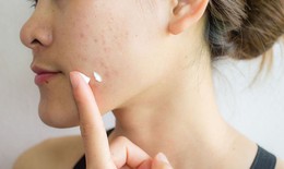 Cách sử dụng 3 hoạt chất thường dùng bôi trị mụn trứng cá