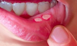 Làm gì khi trẻ bị viêm loét miệng?