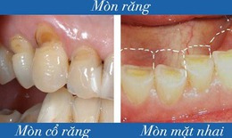M&#242;n răng: Nguy&#234;n nh&#226;n, triệu chứng, c&#225;ch điều trị v&#224; ph&#242;ng bệnh
