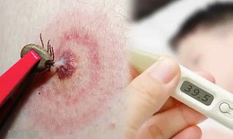 Babesia: Nguy&#234;n nh&#226;n, biểu hiện, c&#225;ch điều trị v&#224; ph&#242;ng bệnh