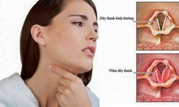 Vi&#234;m thanh quản cấp t&#237;nh: Nguy&#234;n nh&#226;n, triệu chứng, ph&#242;ng bệnh v&#224; c&#225;ch điều trị