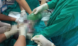 Mổ cứu thai nhi khi sản phụ ngừng tuần hoàn, ngừng hô hấp