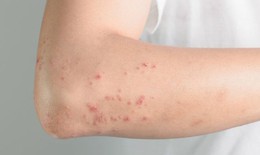 Dấu hiệu nhận biết sốt phát ban dạng sởi
