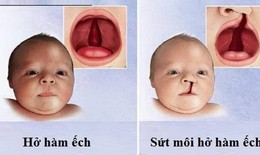 Luyện tập, vật lý trị liệu tốt cho người bệnh hở hàm ếch
