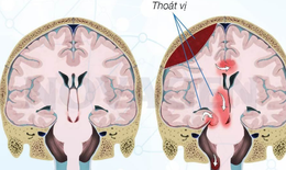 Tho&#225;t vị n&#227;o: Nguy&#234;n nh&#226;n, triệu chứng, chẩn đo&#225;n v&#224; điều trị