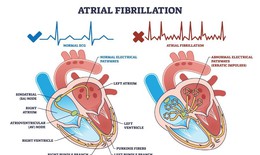 Rối loạn nhịp tim: t&#236;m hiểu những rủi ro tiềm ẩn