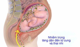 Bệnh viêm màng ối: Nguyên nhân, triệu chứng, phòng bệnh và cách điều trị