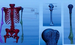 C&#244;ng nghệ in 3D dần được ứng dụng rộng r&#227;i trong kh&#225;m, chữa bệnh