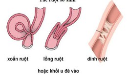 C&#226;u hỏi thường gặp li&#234;n quan đến bệnh tắc ruột sơ sinh