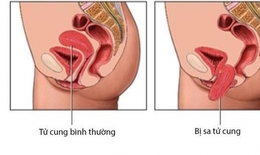 Sa sinh dục có biểu hiện như thế nào?