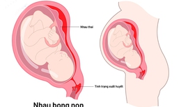 C&#225;c biện ph&#225;p xử tr&#237;, điều trị cho thai phụ bị nhau bong non