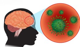 C&#226;u hỏi thường gặp về bệnh vi&#234;m m&#224;ng n&#227;o do n&#227;o m&#244; cầu