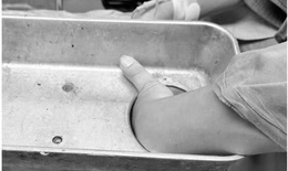 Bị máy xay thịt cuốn, nam thanh niên bê cả máy đi cấp cứu