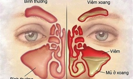 Những người dễ mắc bệnh vi&#234;m xoang