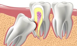 Răng mọc lạc chỗ c&#243; dấu hiệu g&#236;?