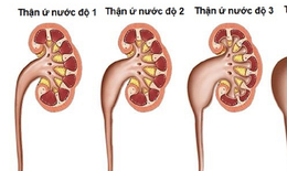 Thận ứ nước: Nguyên nhân, triệu chứng và cách điều trị